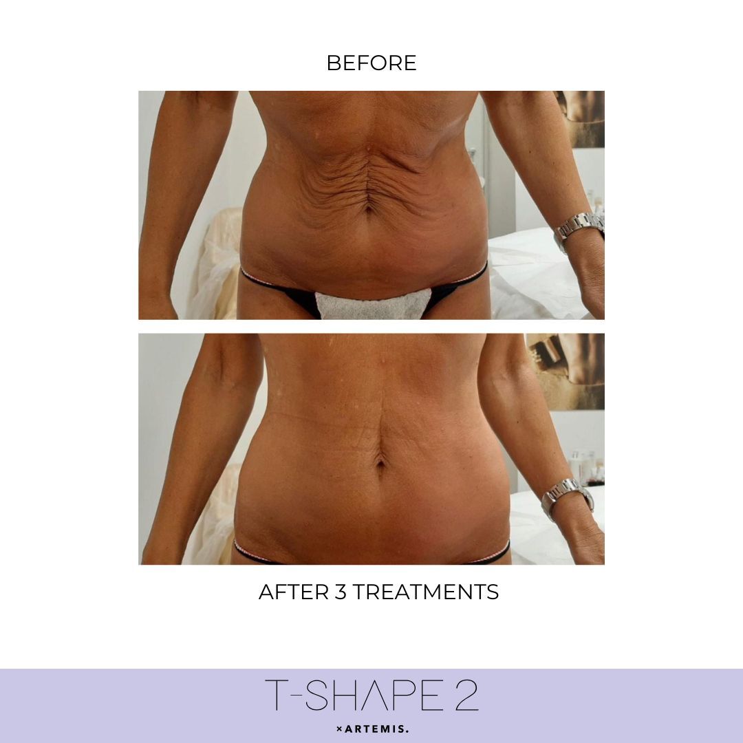 T-Shape 2 abdomen result after 3 treatments