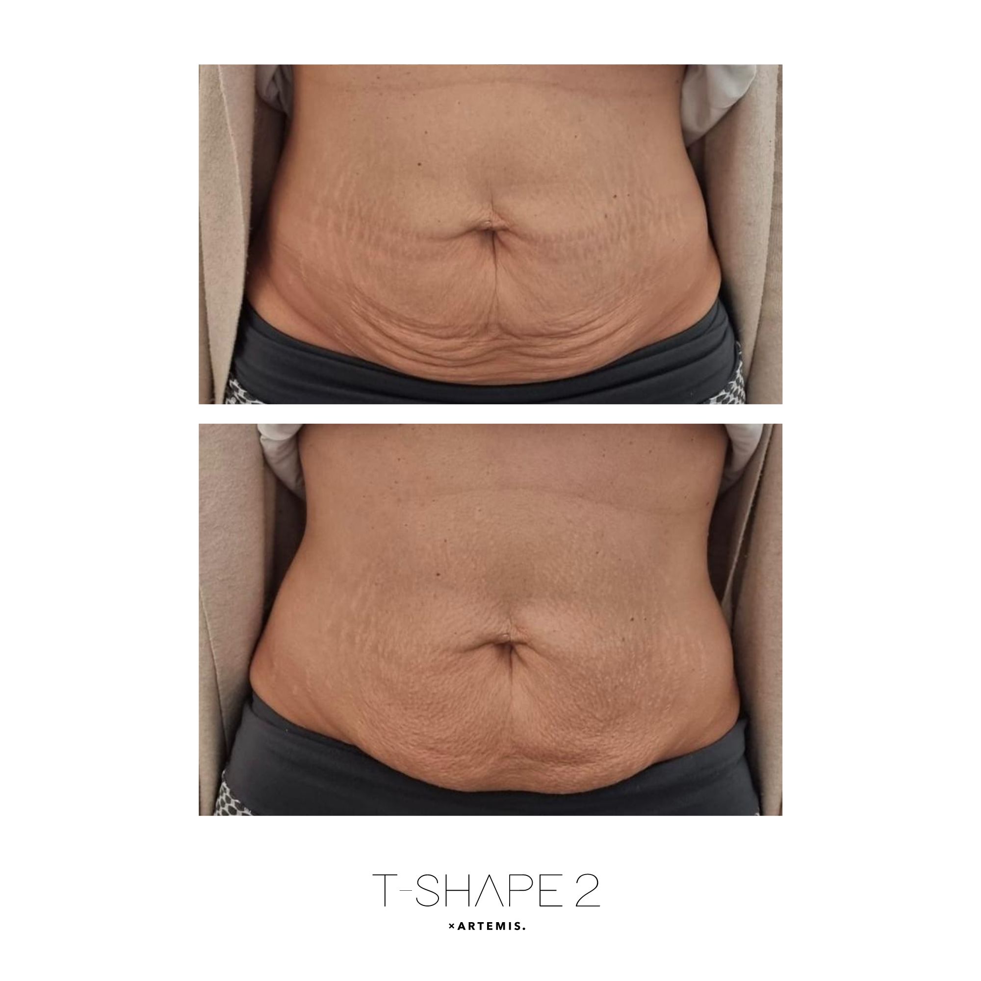 T-Shape 2 abs result after treatment series