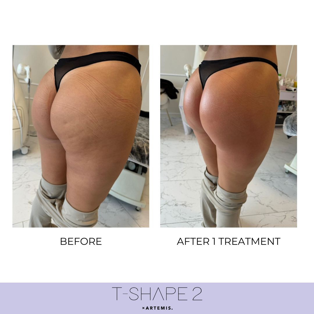 T-Shape 2 body result after 1 treatment