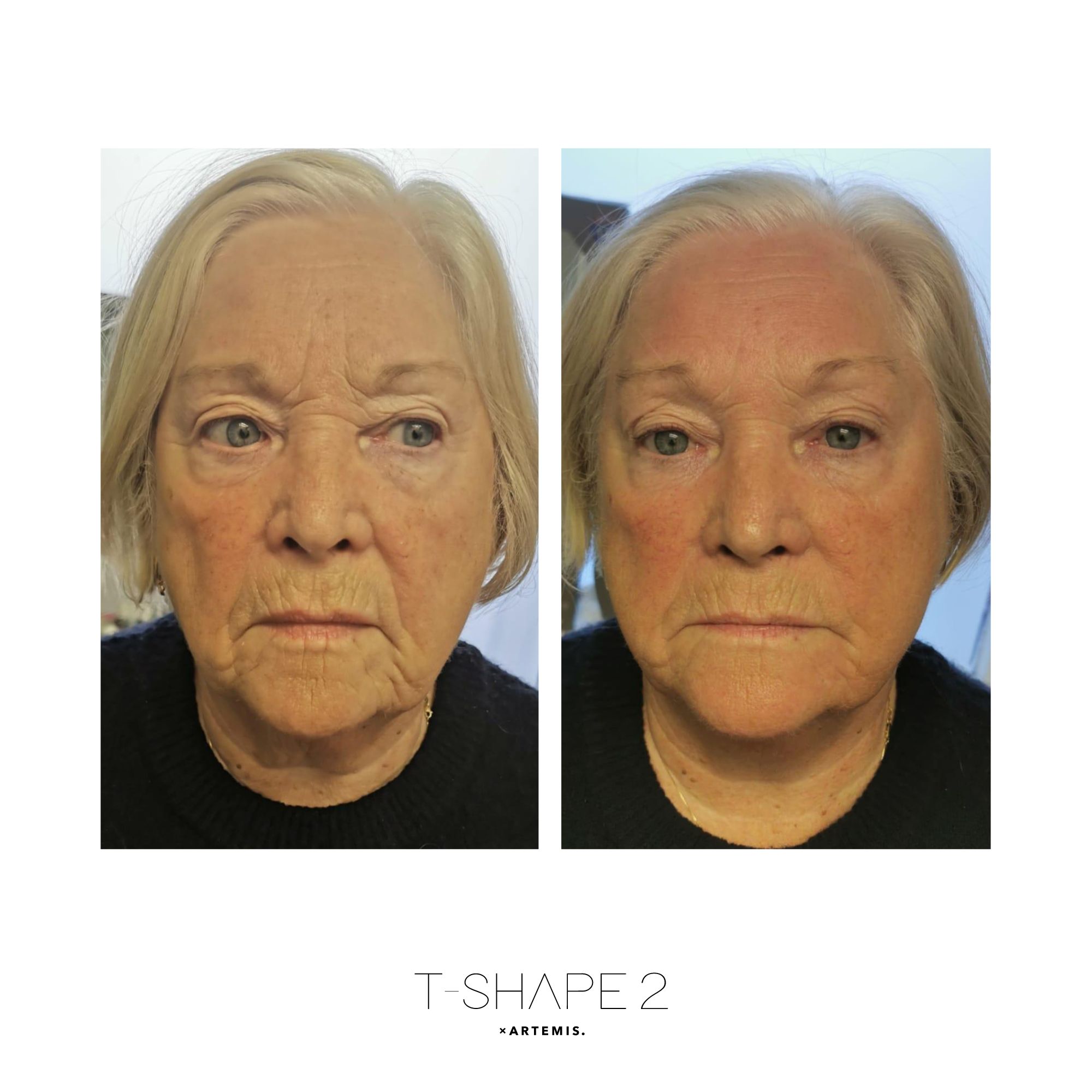 T-Shape 2 face result after 1 treatment