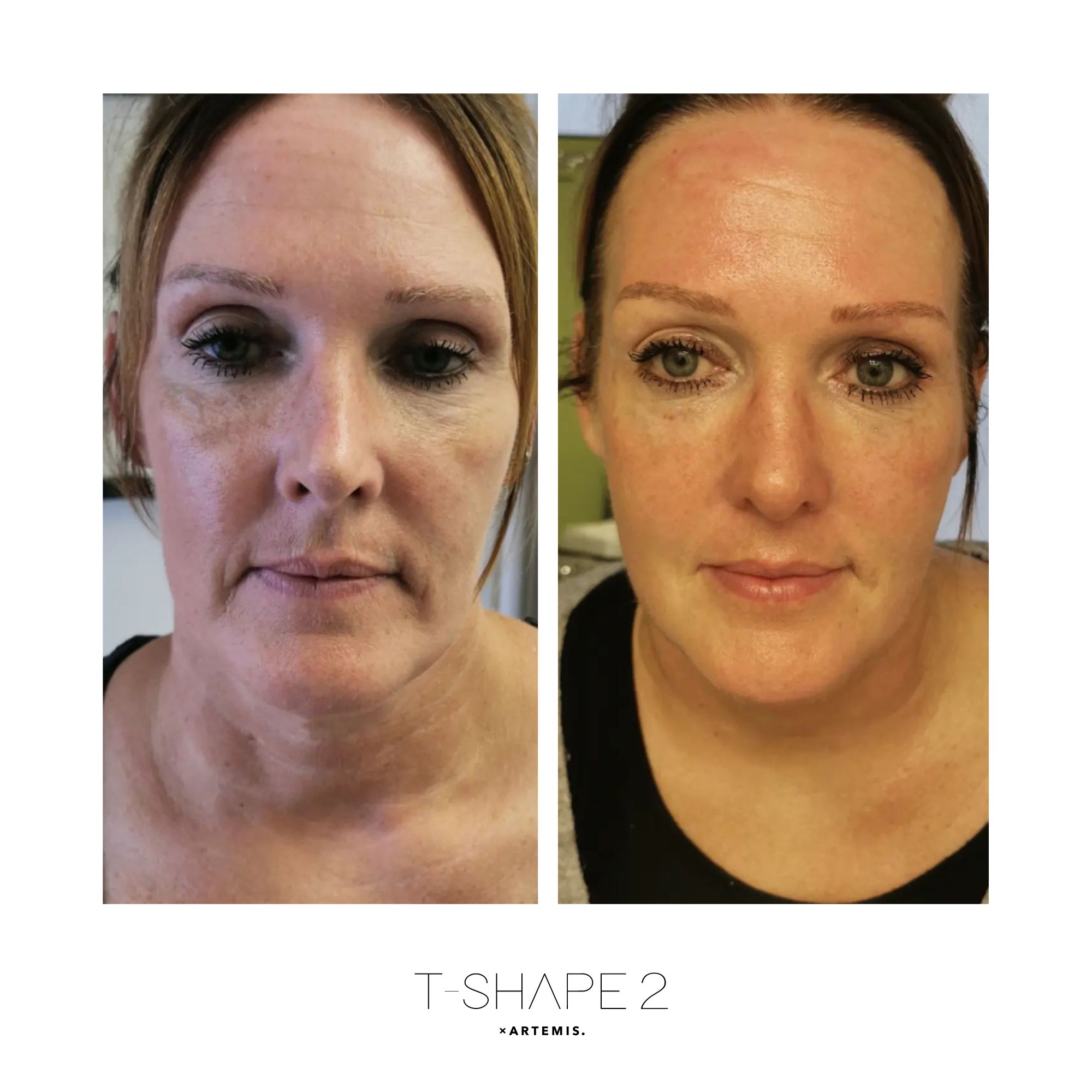 T-Shape 2 face result after 4 treatments
